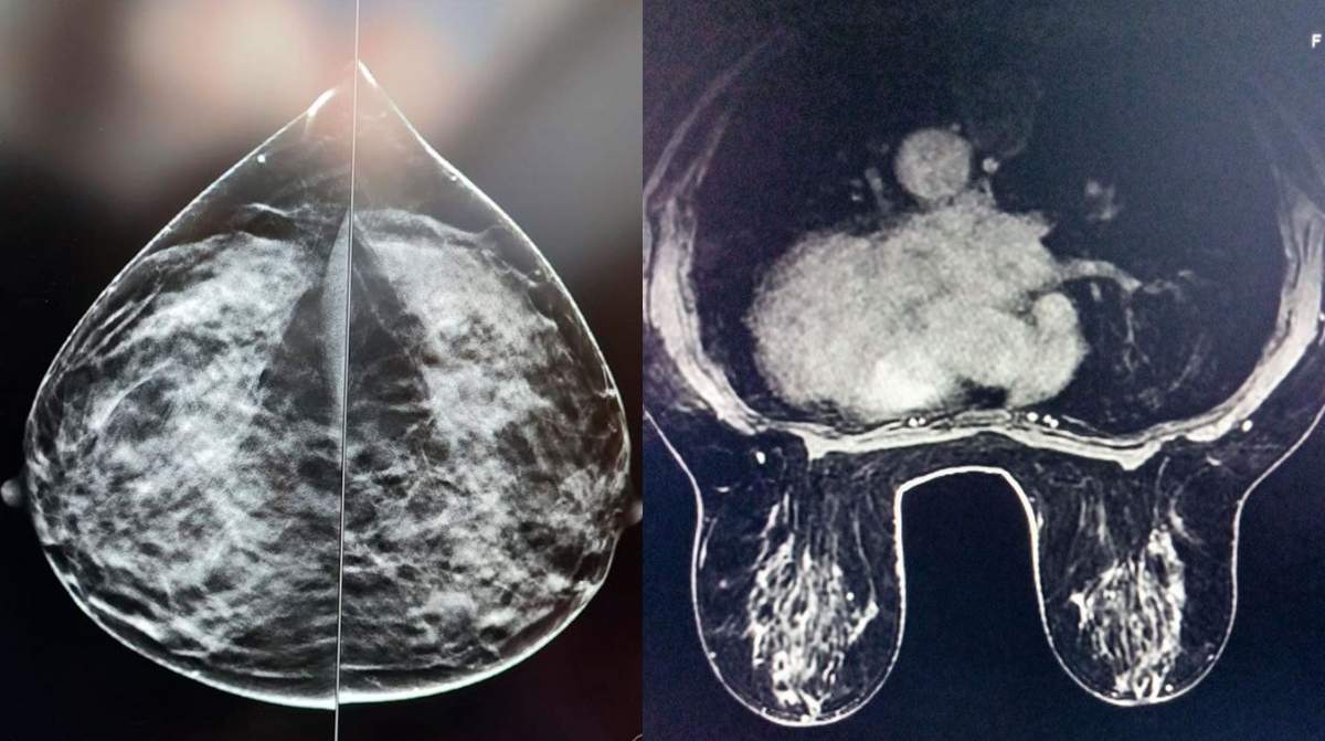 Cáncer de mama detectado en pruebas médicas vinculado al trabajo nocturno en enfermera francesa