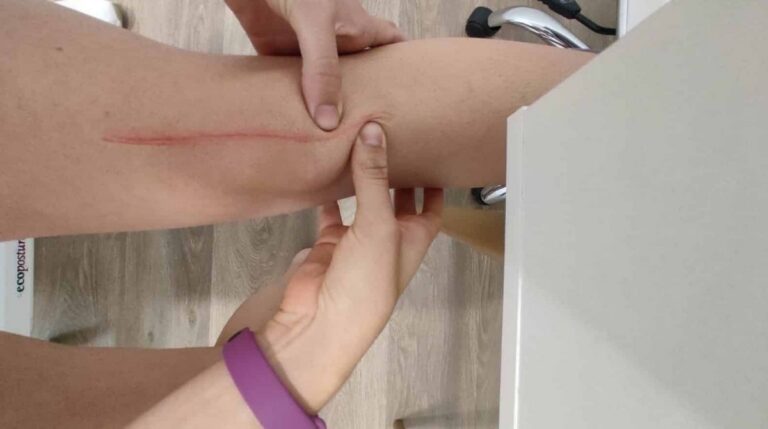 Cicatriz de la operación de una protesis de rodilla
