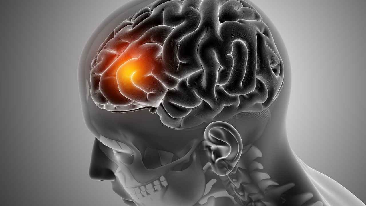 Ilustración médica de un cerebro con una zona afectada por un ictus